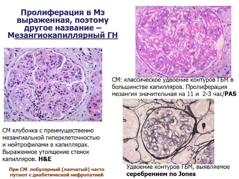 СМ клубочка с преимущественно мезангиальной гиперклеточностью и нейтрофилами в капиллярах. Выраженное утолщение стенок капилляров.